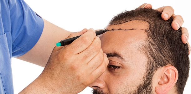 Haartransplantation bei Männern