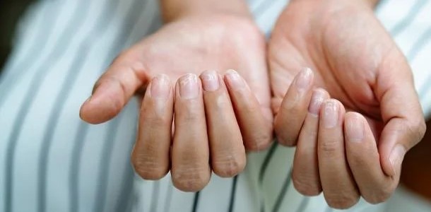Was Fingernägel über unsere Gesundheit sagen