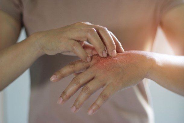 Was Sie gegen Neurodermitis tun können