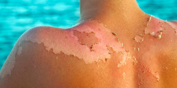 Tipps und Hilfe gegen Sonnenbrand